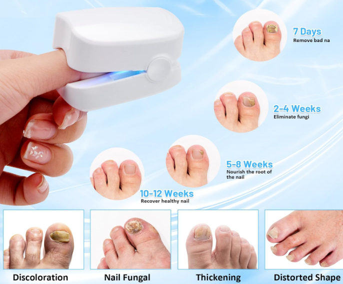 🔥 𝗧𝗿𝗮𝗶𝘁𝗲𝗺𝗲𝗻𝘁 𝗱𝗲𝘀 𝗺𝘆𝗰𝗼𝘀𝗲𝘀 𝗱𝗲𝘀 𝗼𝗻𝗴𝗹𝗲𝘀 : 𝗿𝗮𝗽𝗶𝗱𝗲, 𝗲𝗳𝗳𝗶𝗰𝗮𝗰𝗲 𝗲𝘁 𝗮̀ 𝗱𝗼𝗺𝗶𝗰𝗶𝗹𝗲