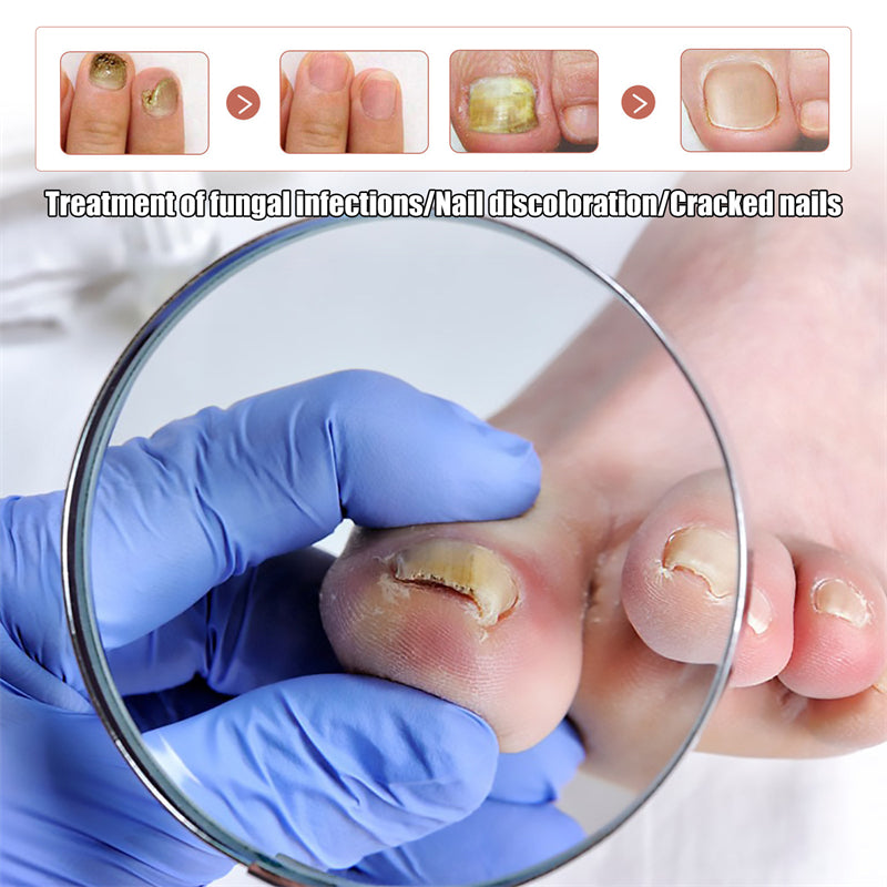 🔥 𝗧𝗿𝗮𝗶𝘁𝗲𝗺𝗲𝗻𝘁 𝗱𝗲𝘀 𝗺𝘆𝗰𝗼𝘀𝗲𝘀 𝗱𝗲𝘀 𝗼𝗻𝗴𝗹𝗲𝘀 : 𝗿𝗮𝗽𝗶𝗱𝗲, 𝗲𝗳𝗳𝗶𝗰𝗮𝗰𝗲 𝗲𝘁 𝗮̀ 𝗱𝗼𝗺𝗶𝗰𝗶𝗹𝗲