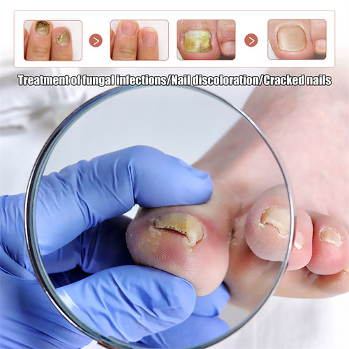 🔥 𝗧𝗿𝗮𝗶𝘁𝗲𝗺𝗲𝗻𝘁 𝗱𝗲𝘀 𝗺𝘆𝗰𝗼𝘀𝗲𝘀 𝗱𝗲𝘀 𝗼𝗻𝗴𝗹𝗲𝘀 : 𝗿𝗮𝗽𝗶𝗱𝗲, 𝗲𝗳𝗳𝗶𝗰𝗮𝗰𝗲 𝗲𝘁 𝗮̀ 𝗱𝗼𝗺𝗶𝗰𝗶𝗹𝗲